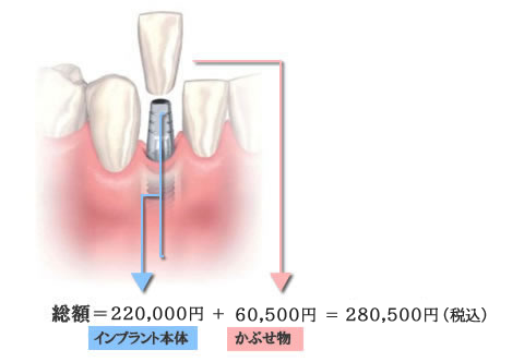 1ピースインプラント