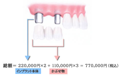 1ピースインプラント