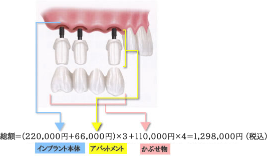 2ピースインプラント